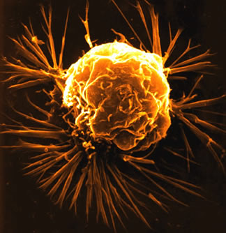 Breast Cancer Treatment Centres India